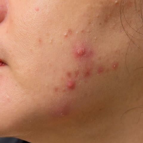 ปานกลาง: มีสิวอุดตัน ตุ่มแดง ตุ่มหนอง