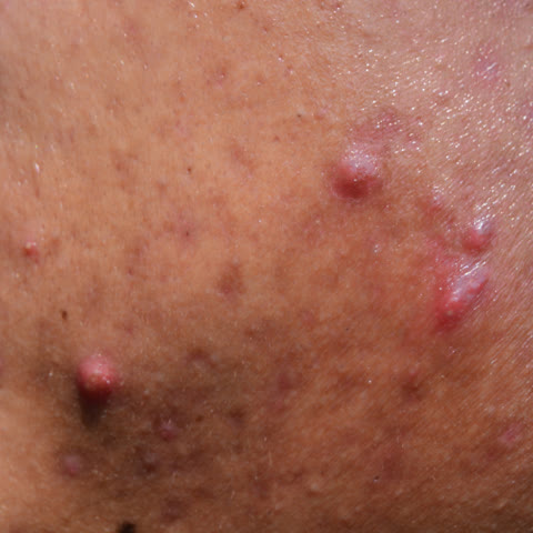 สิวหัวช้าง: สิวอักเสบที่มีหัวสิวขนาดใหญ่ เป็นตุ่ม หรือ ก้อนไตสีแดง มีอาการเจ็บรุนแรงแม้ไม่ ได้กด อาการเจ็บอาจร้าวไป ที่ผิวหนังรอบๆ