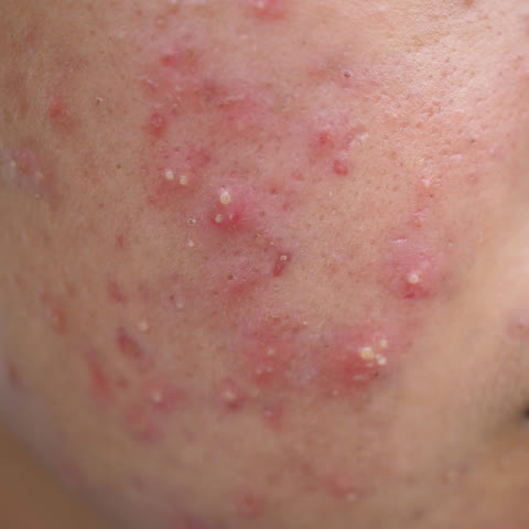 สิวหัวหนอง: สิวที่มีตุ่มบวมแดงที่ฐาน ด้านบนเป็นหนองสีเหลือง