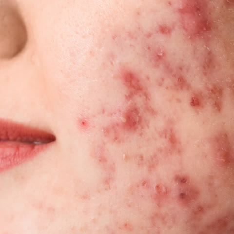 รุนแรง: มีตุ่มแดง ตุ่มหนอง จำนวนมาก มีตุ่มนูนบางส่วน