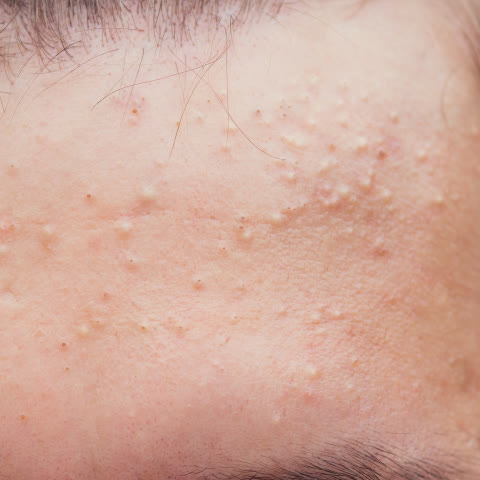 สิวหัวปิด: สิวอุดตันที่มีลักษณะเป็นตุ่ม เล็กๆ สีขาวหัวปิด